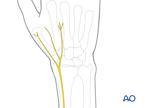 dorsal approach for joint spanning plate