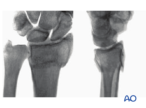 Extraarticular fracture of the radius with dorsal displacement or tilt (Colles) X-rays