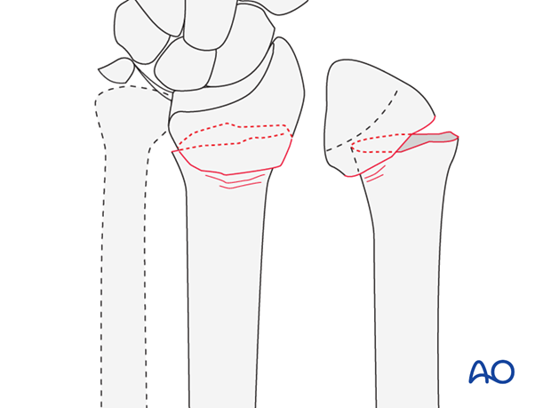 Extraarticular radial fracture with volar displacement or tilt (Smith's)