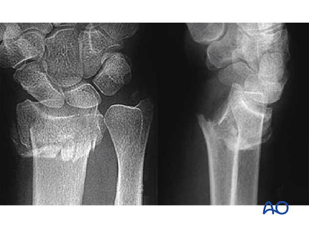 wedge or multifragmentary fracture X-rays