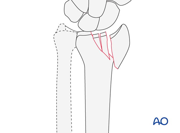 Sagittal multifragmentary fracture involving the scaphoid fossa