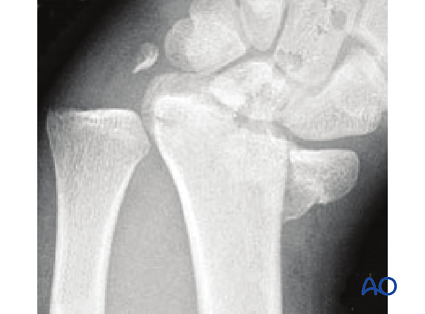 Sagittal multifragmentary fracture involving the scaphoid fossa X-rays