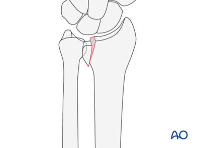 Partial articular, sagittal fracture of the radius, involving the ...