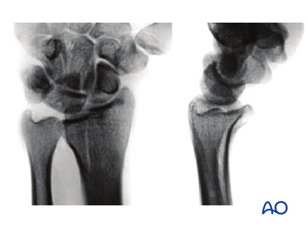 Sagittal fracture involving the lunate fossa X-rays