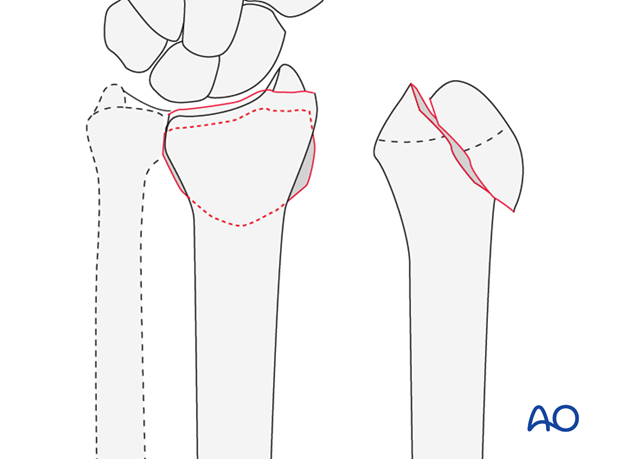 Partial articular, simple fracture of the radius, involving the dorsal rim (Barton's)