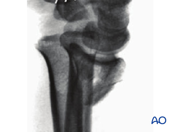 Partial articular, simple fracture of the radius, involving the dorsal rim (Barton's) x-rays