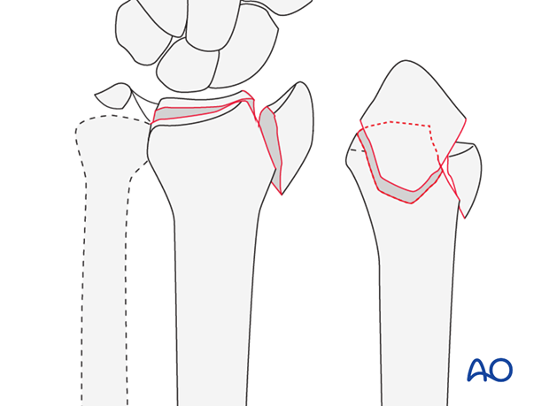 Partial articular, fragmentary fracture of the radius, involving the dorsal rim (Barton's)