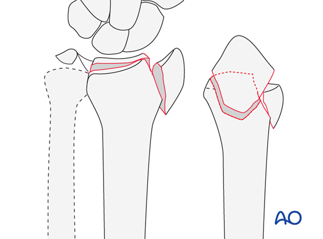 Partial articular, fragmentary fracture of the radius, involving dorsal ...