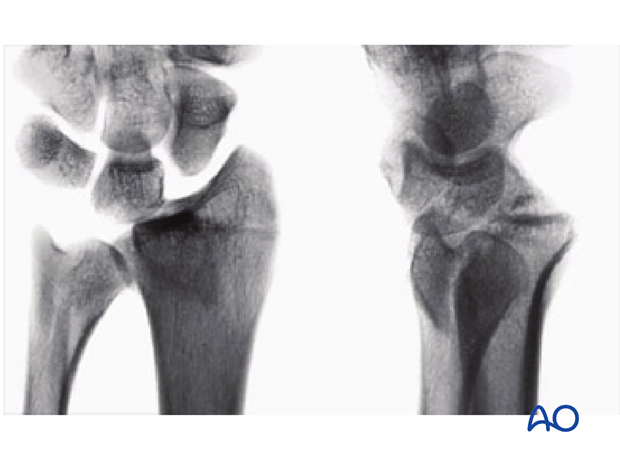 Partial articular, fragmentary fracture of the radius, involving the dorsal rim (Barton's) x-rays