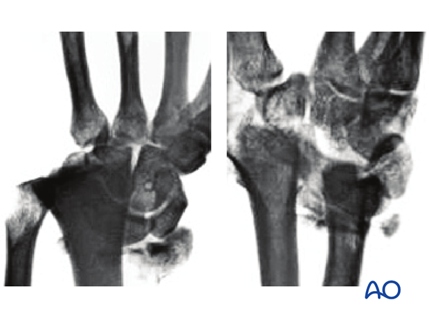 Partial articular fracture of the radius with dorsal dislocation x-rays