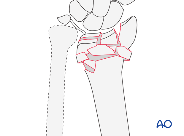 Complete articular fracture of the radius, articular multifragmentary, metaphyseal multifragmentary