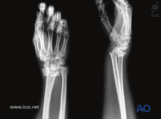 Fragmentary intraarticular displaced distal radial fracture