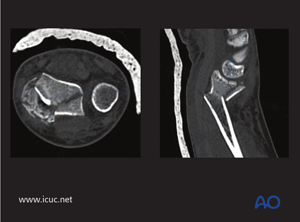 CT images showing fragmentary intraarticular fractures