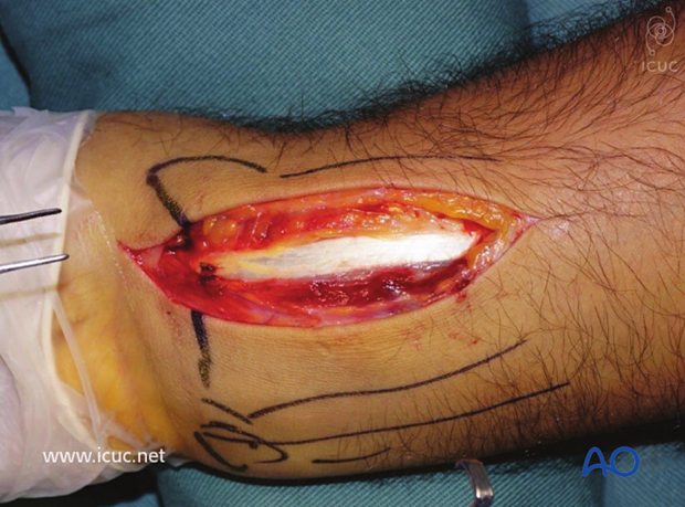 Flexor carpal radialis tendon is exposed