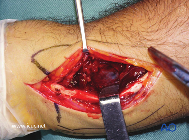 Pronator quadratus is seen beneath the tendon sheath and retracted towards the ulnar side