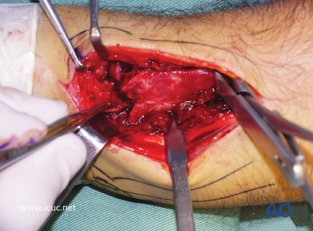 Exposure of the severely displaced distal radial fracture