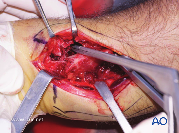 The fracture is cleaned of hematoma and the dorsal fragments are distracted distally to initiate the reduction maneuver