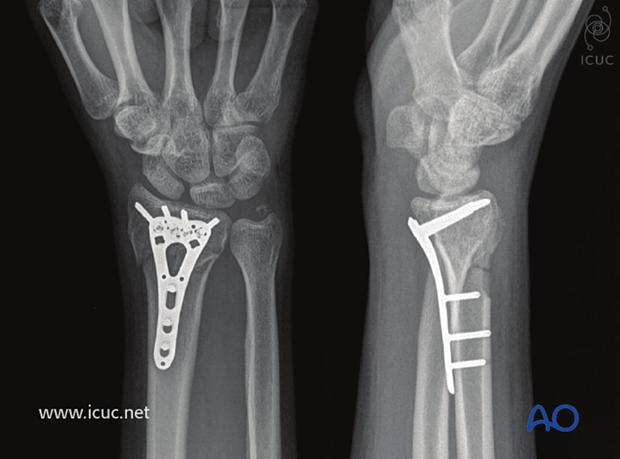 Four-week images of healing fracture