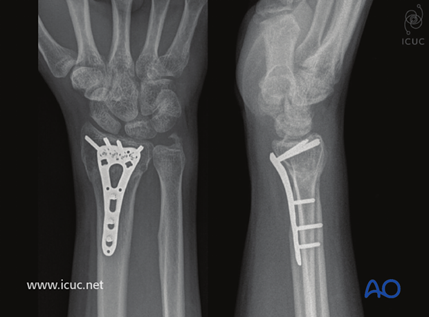 18 week images showing healed fracture