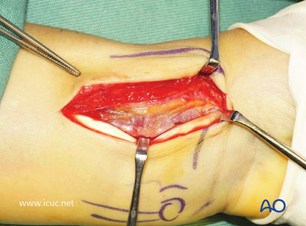 Flexor carpi radialis tendon is retracted towards the ulna and the incision is continued through the volar tendon sheath