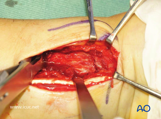 The distal radial fracture is demonstrated and reduced