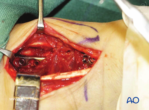 Pronator quadratus is used to cover the plate during closure
