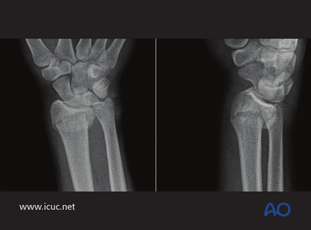 Extra articular distal radial fracture in a 20-year-old, with dorsal displacement