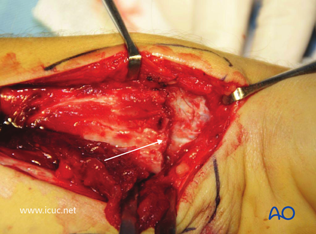Pronator quadratus has been subperiosteally dissected and reflected, exposing the fracture beneath