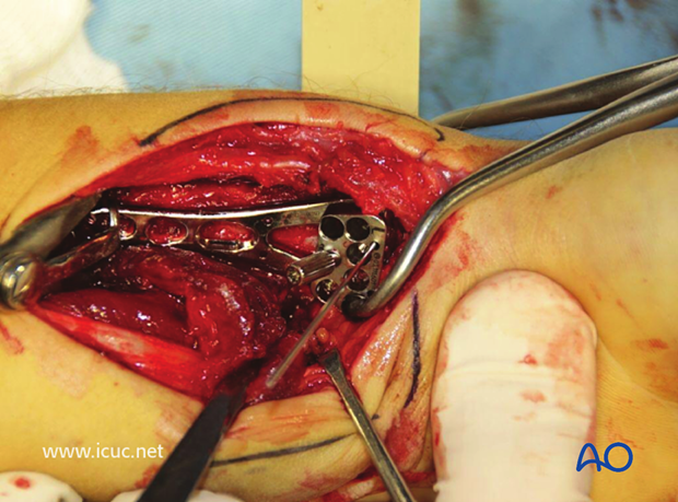 A variable angle plate has been placed on the distal radius with a K-wire used for targeting