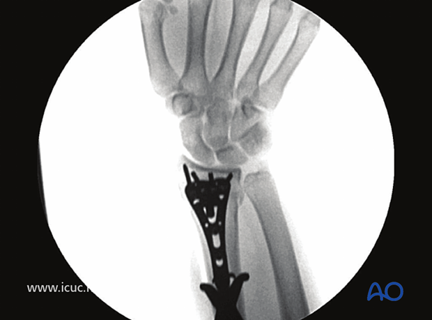 Fluoroscopic image demonstrating all distal screws are extraarticular