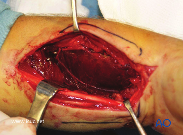 Initial closure with the volar plate covered with the pronator quadratus