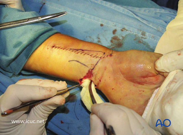 Final closure of the Henry approach. This injury was accompanied by a small volar open wound
