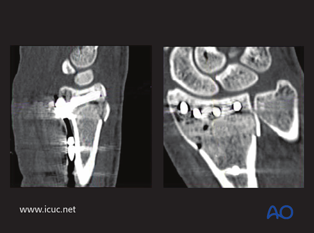 Postoperative CT showing extraarticular position of variable angle screws