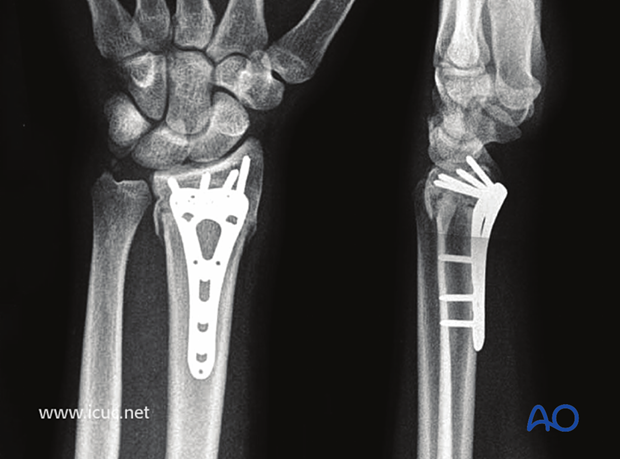 5 weeks postoperative images showing healing of the distal radius