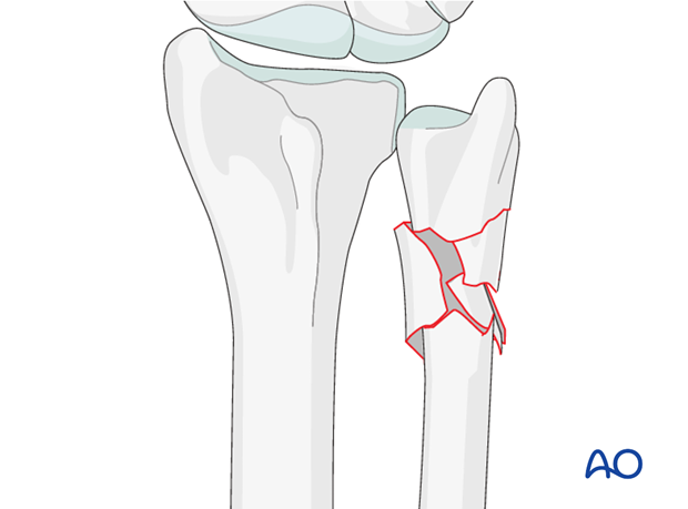 orif bridge plate