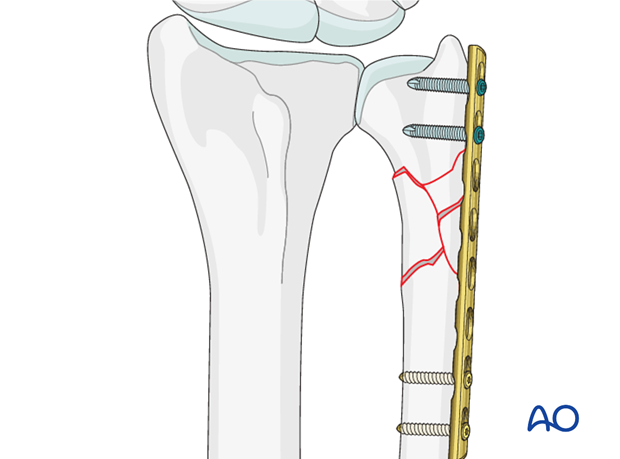 extraarticular multifragmentary fracture of the ulna