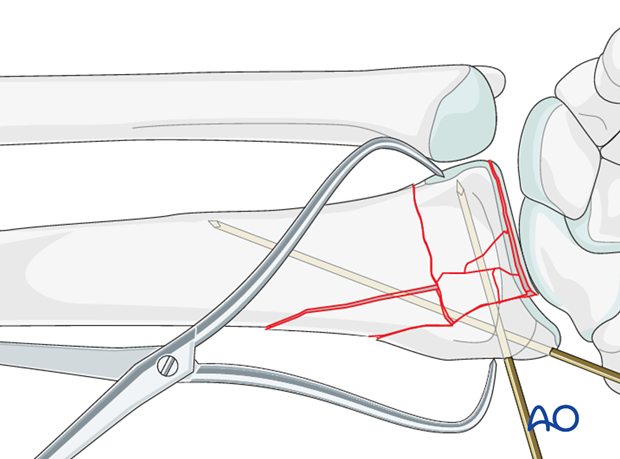 orif palmar bridge plate