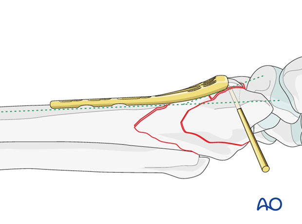 orif palmar bridge plate