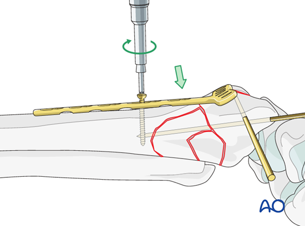 orif palmar bridge plate