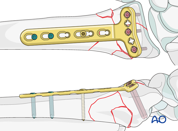 orif palmar bridge plate