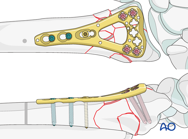 orif palmar bridge plate