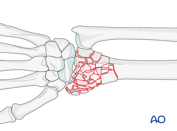 orif joint spanning distraction plate