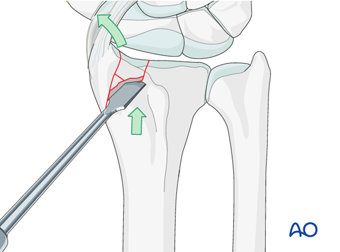 ORIF - Radial column plate for Partial articular, sagittal ...