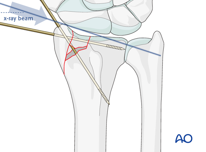 ORIF - Lag screws/K-wires for Partial articular, sagittal ...