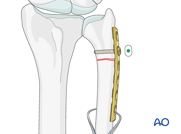 orif compression plate