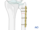 extraarticular simple fracture of the ulna
