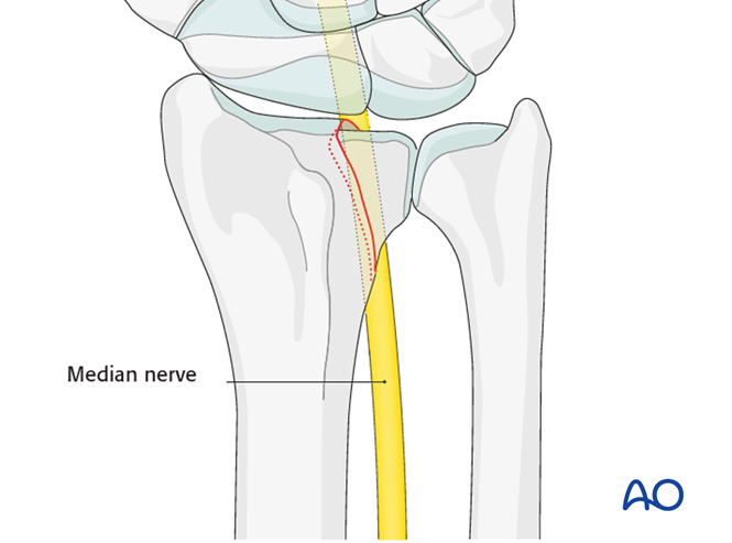 ORIF - Dorsal plate for Partial articular, sagittal fracture of the ...