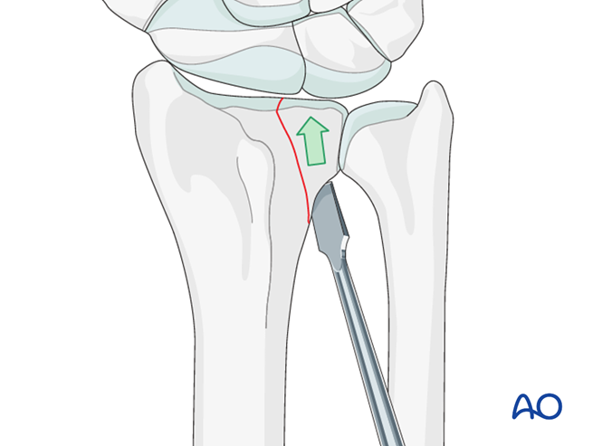 ORIF - Dorsal plate for Partial articular, sagittal fracture of the ...