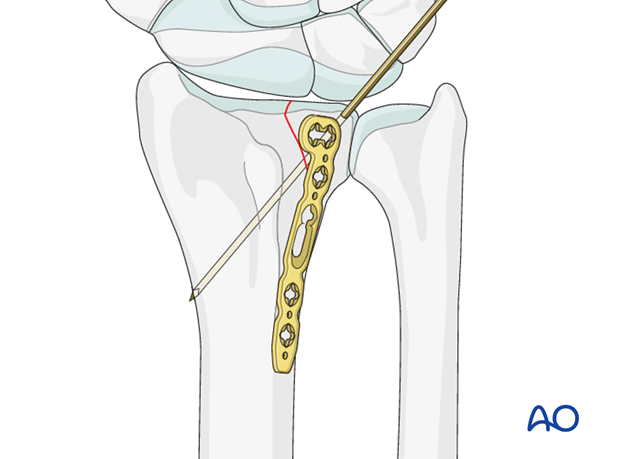 orif dorsal plate