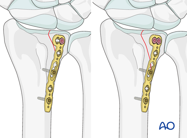 partial articular sagittal fracture of the radius involving the lunate fossa